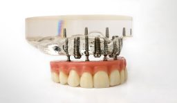 Types of Dental Bridges and the Procedure for Having Them