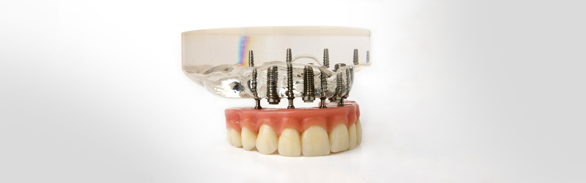 Types of Dental Bridges and the Procedure for Having Them